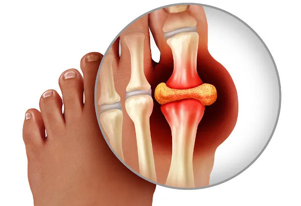 Imagem da inflamação do dedão que acontece com a Gota