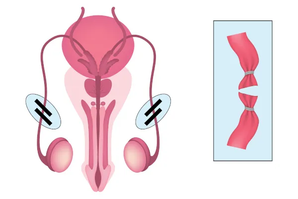 Imagem ilustrativa sobre como funciona a vasectomia em homens